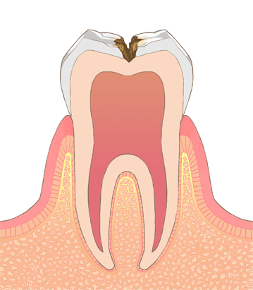 おさふねフレンド歯科 C2（象牙質の虫歯）