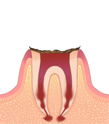 おさふねフレンド歯科 C4（歯の根まで進行した虫歯）